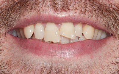 Adult Braces & Bonding before